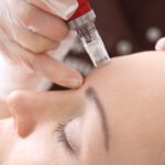 Trattamento estetico di biostimolazione microneedling
